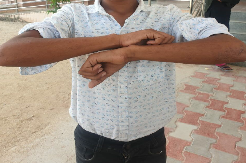 Skin Infection Concerns Spark Hygiene Drive in Karnataka’s Government Residential Schools